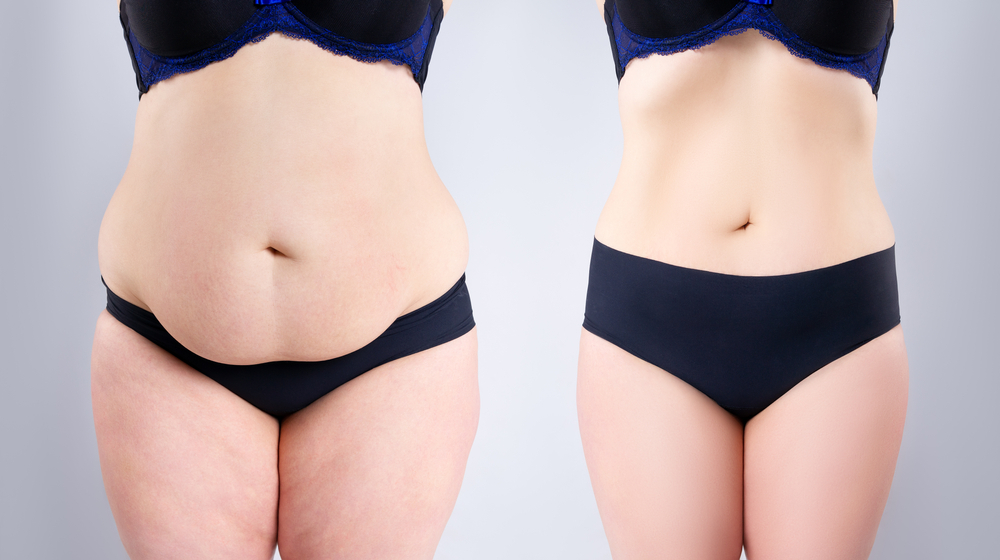 Abdominoplasty or Tummy Tuck Surgery: Causes, Procedure, Recovery