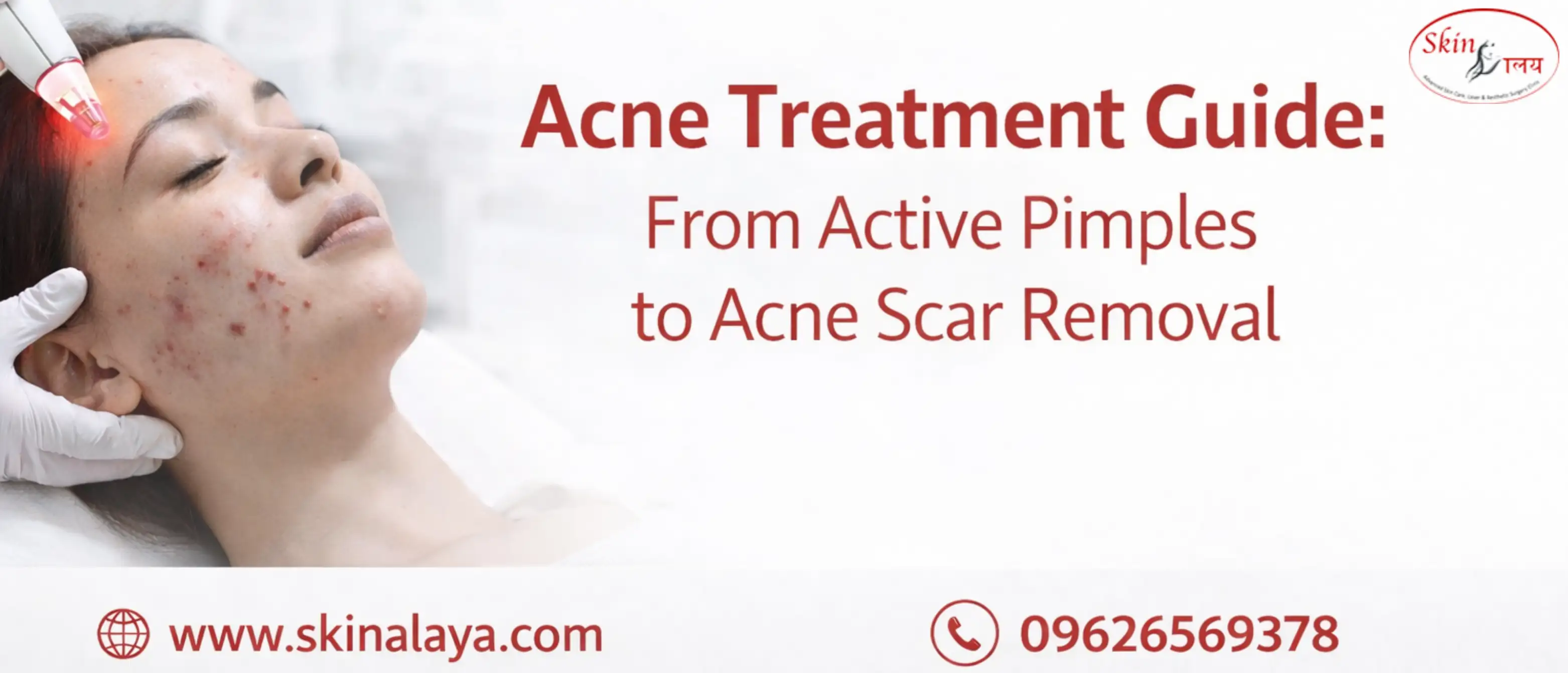 acne-treatment-guide-pimples-to-acne-scar-removal