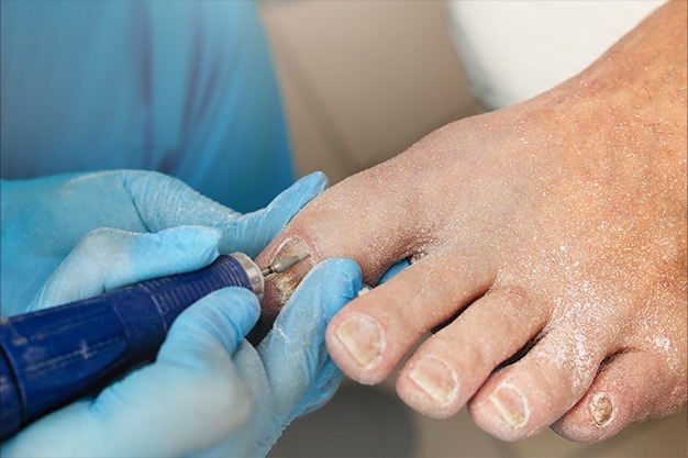 Silver Nitrate - an alternative to phenol in nail surgery