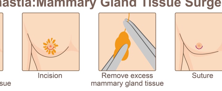 gynecomastia surgery