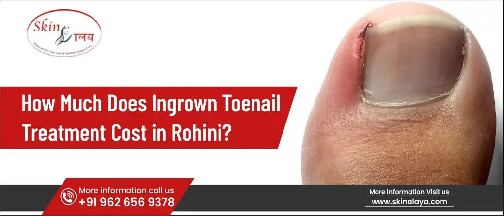 ingrown-toenail-treatment-rohini
