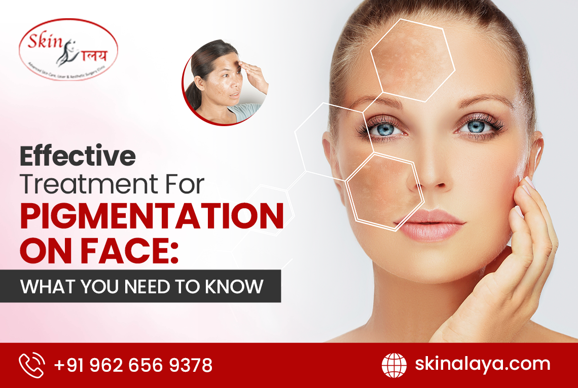 Treatment For Pigmentation