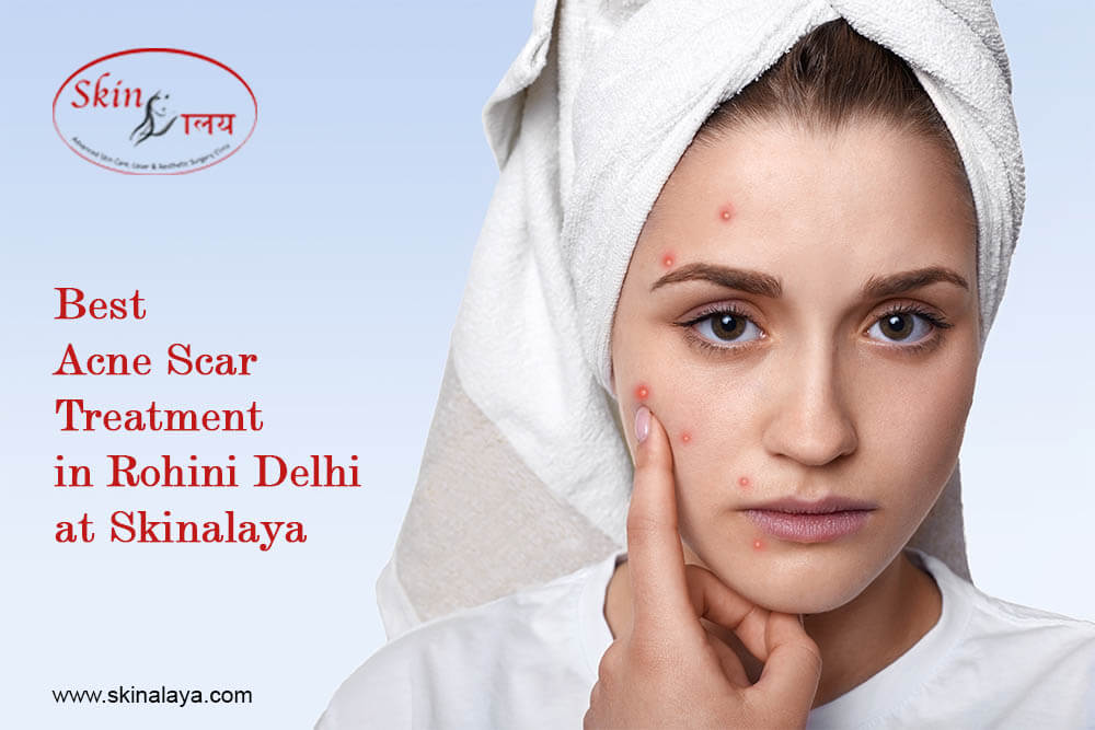 Best Acne Treatment in Rohini Delhi